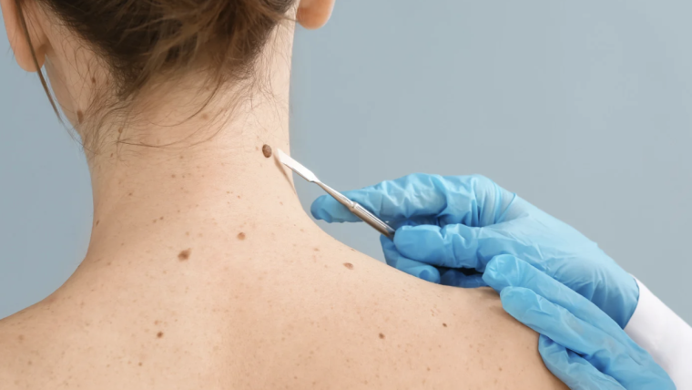 Where to Book a Same-Day Skin Check Appointment in Arlington